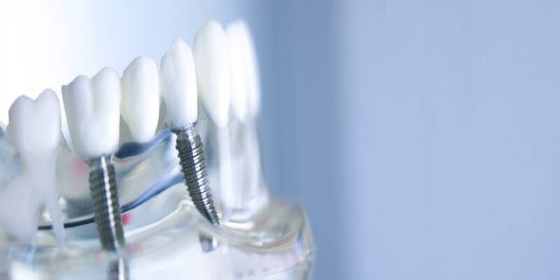 https://www.lovesparkfamilydental.com/wp-content/uploads/2019/12/Dental-Implants-Banner