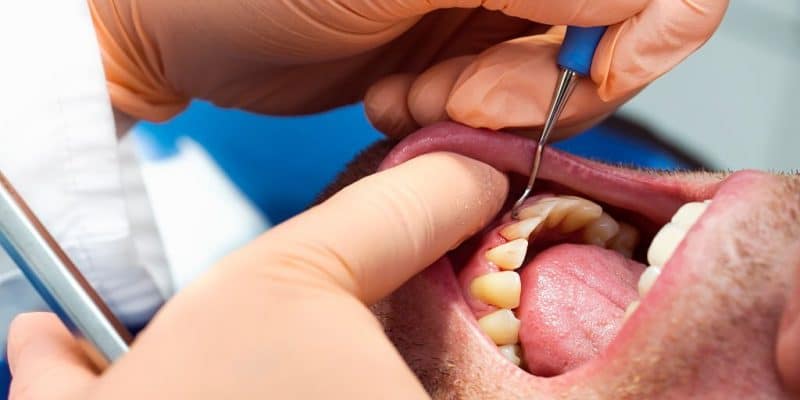 Can Teeth Affected by Periodontal Disease Be Saved