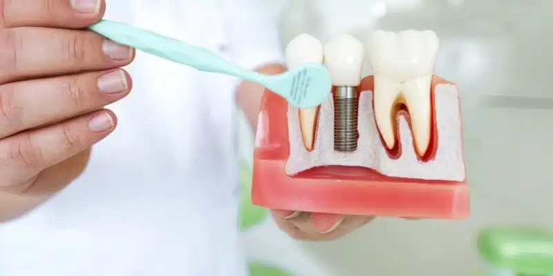 Dental Implants in Illinois
