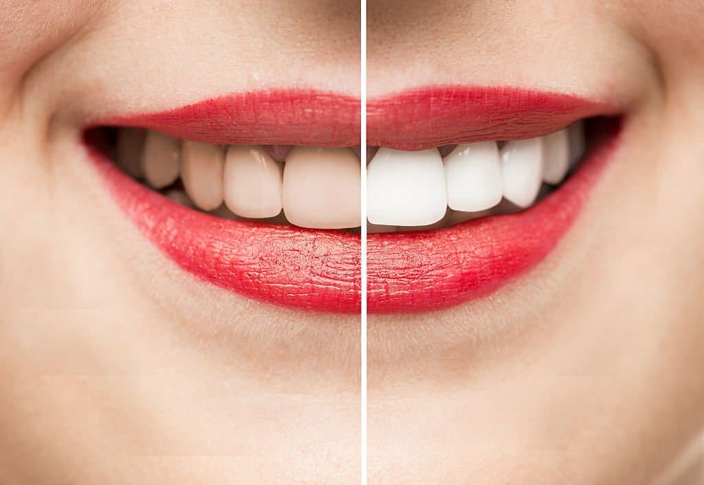 teeth whitening and cleaning