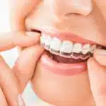 Everything You Need to Know About Invisalign Dentists_FI