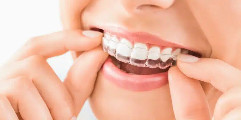 Everything You Need to Know About Invisalign Dentists_FI