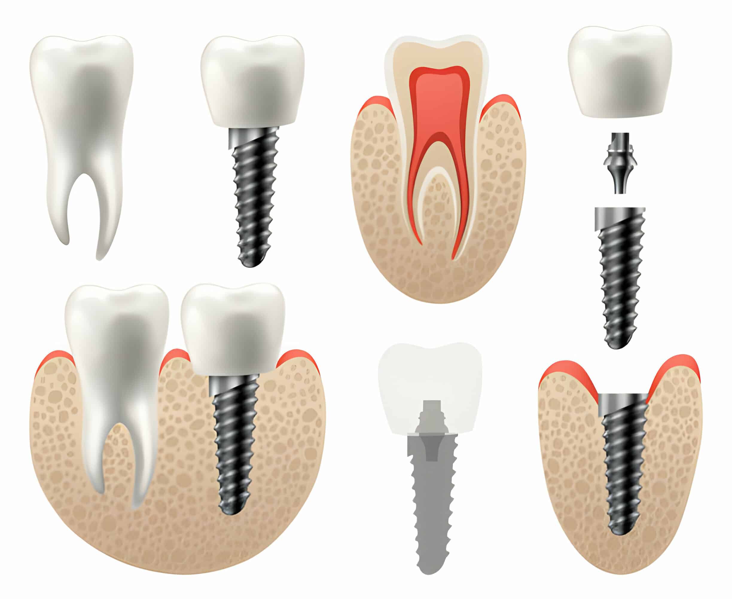 Dental Implants: A Long-Term Investment in Your Oral Health_1