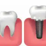 Dental Implants: A Long-Term Investment in Your Oral Health_FI
