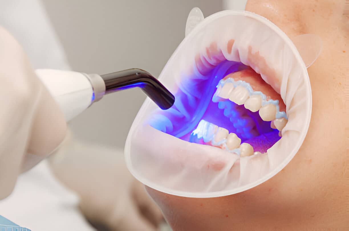Your Guide to Teeth Whitening at Loves Park Family Dental in Loves Park_1