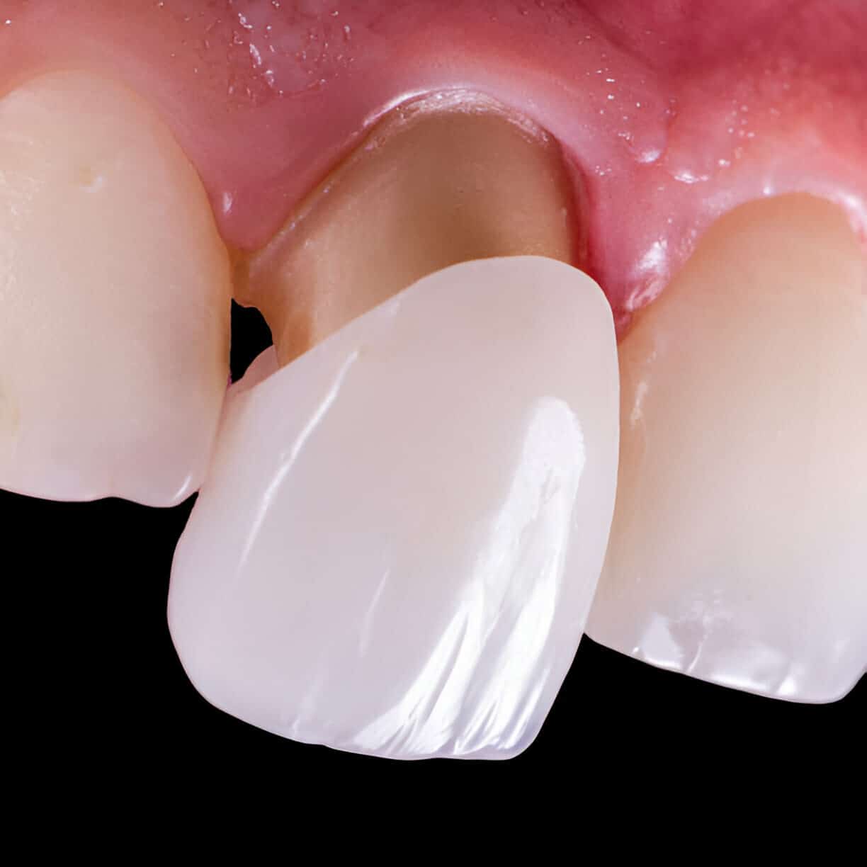 A Guide to Veneers: How Loves Park Family Dental Enhances Your Smile in Loves Park, IL_1