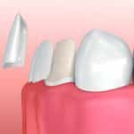 A Guide to Veneers: How Loves Park Family Dental Enhances Your Smile in Loves Park, IL_FI