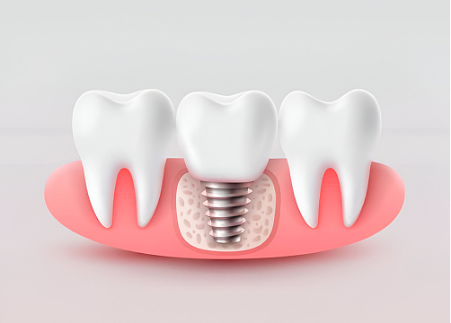 Restore Your Smile with Dental Implants at Loves Park Family Dental, the Trusted Dentist in Loves Park, Illinois