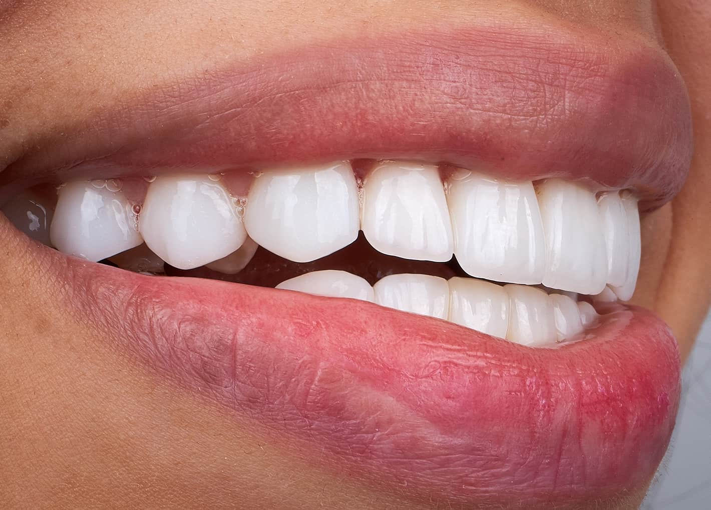 Smiling patient after dental bonding treatment