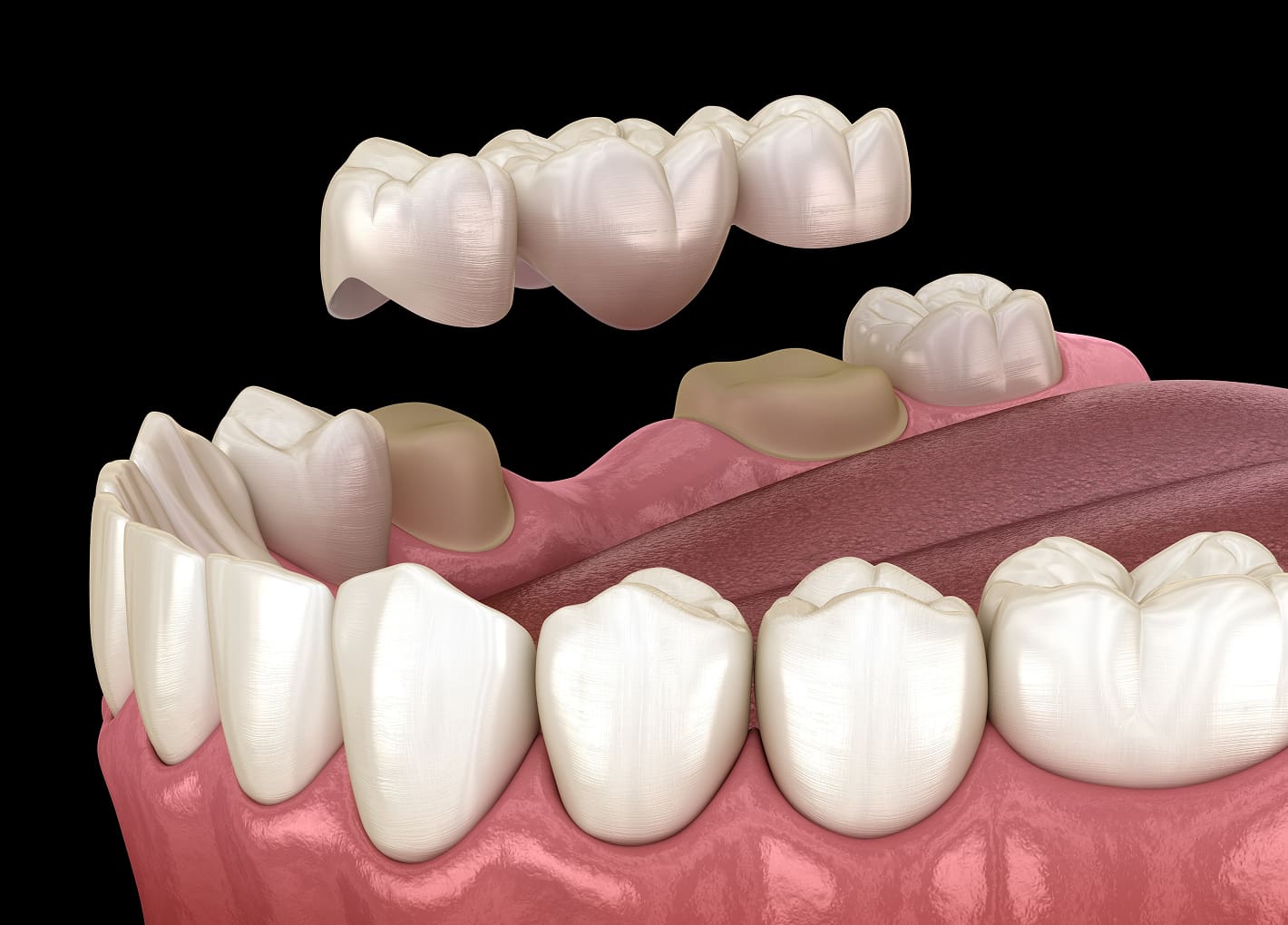 Patient smiling confidently with a dental bridge