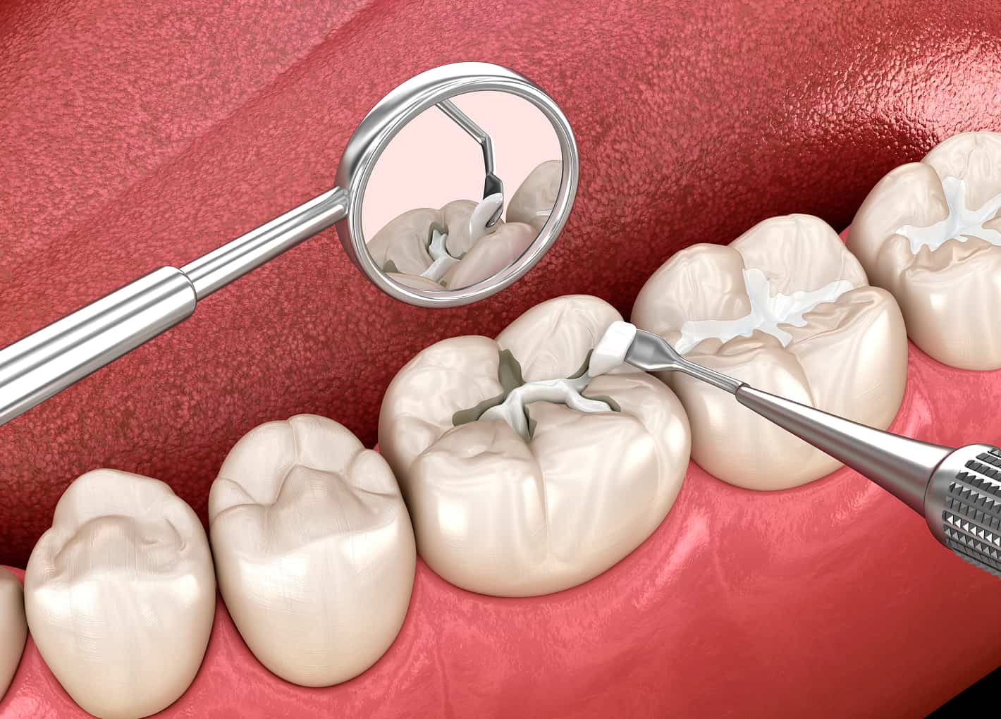 Dentist applying a dental filling to a patient's tooth