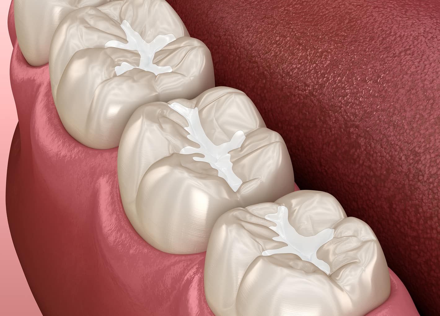 Dentist applying sealant to a child's molar