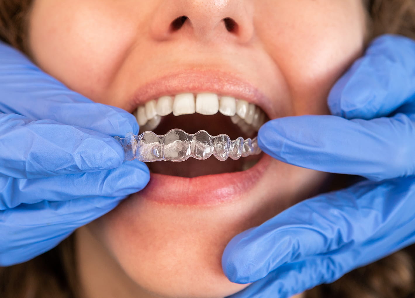 Teen wearing clear Invisalign aligners