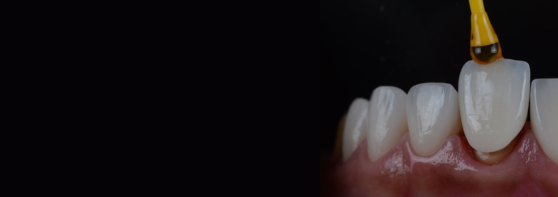 Veneers Banner Image