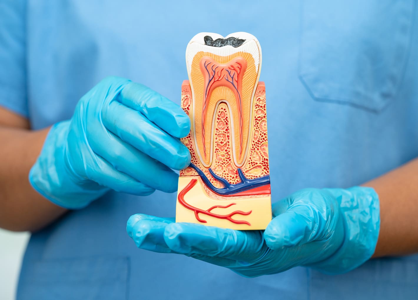Root Canal Treatment