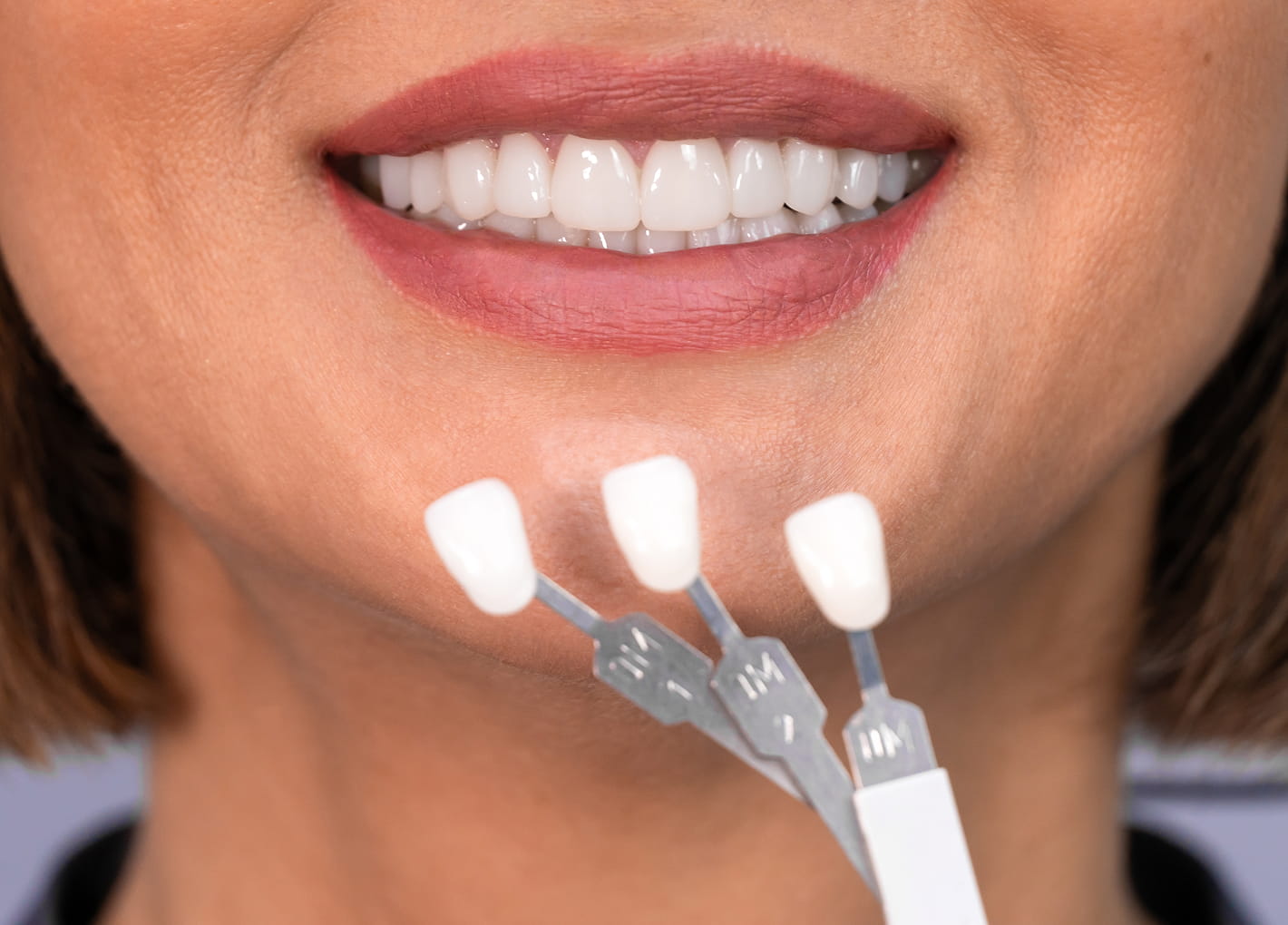 Veneers