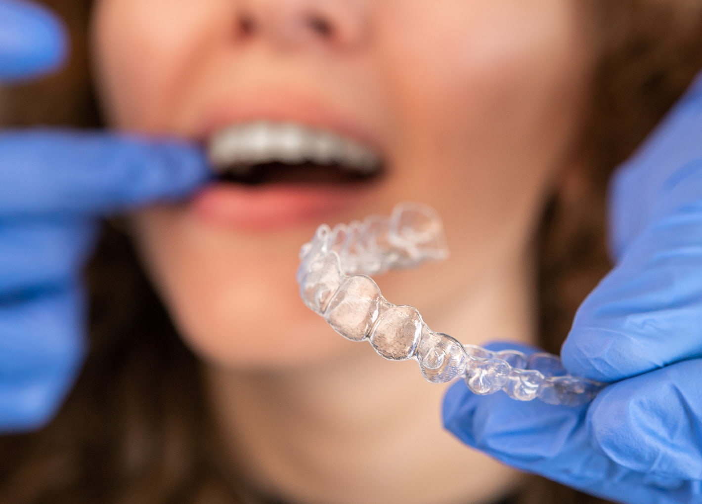 Invisalign