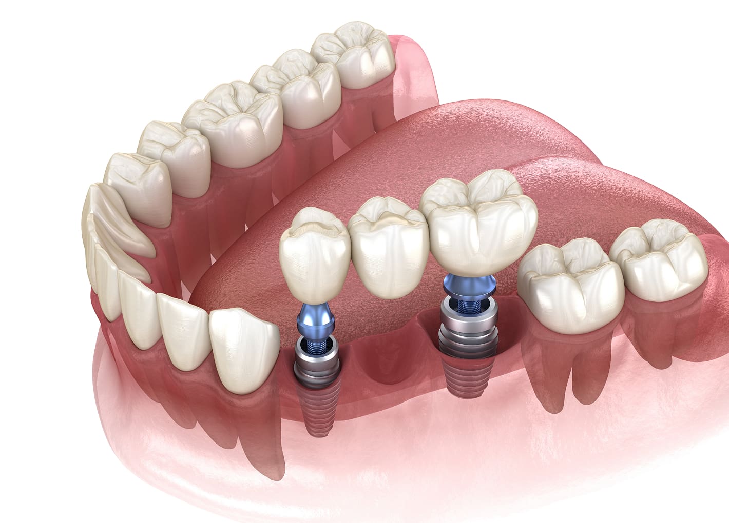 Dental Bridges