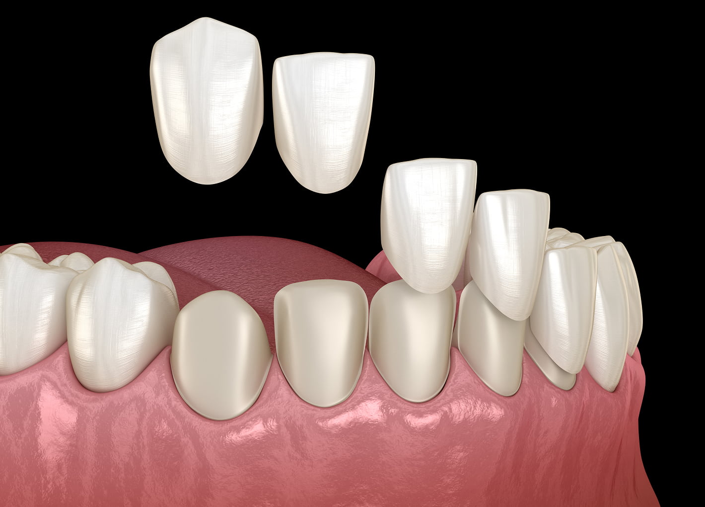 Partial & Full Dentures