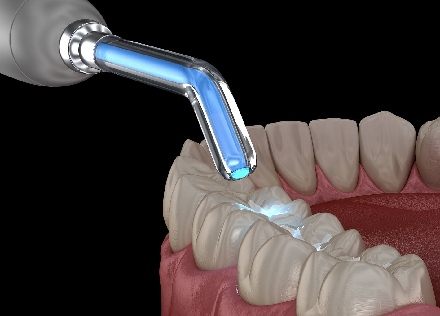 Dental Fillings