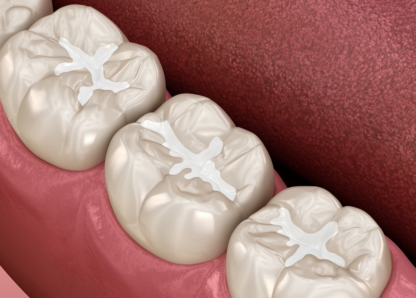 Dental Sealants