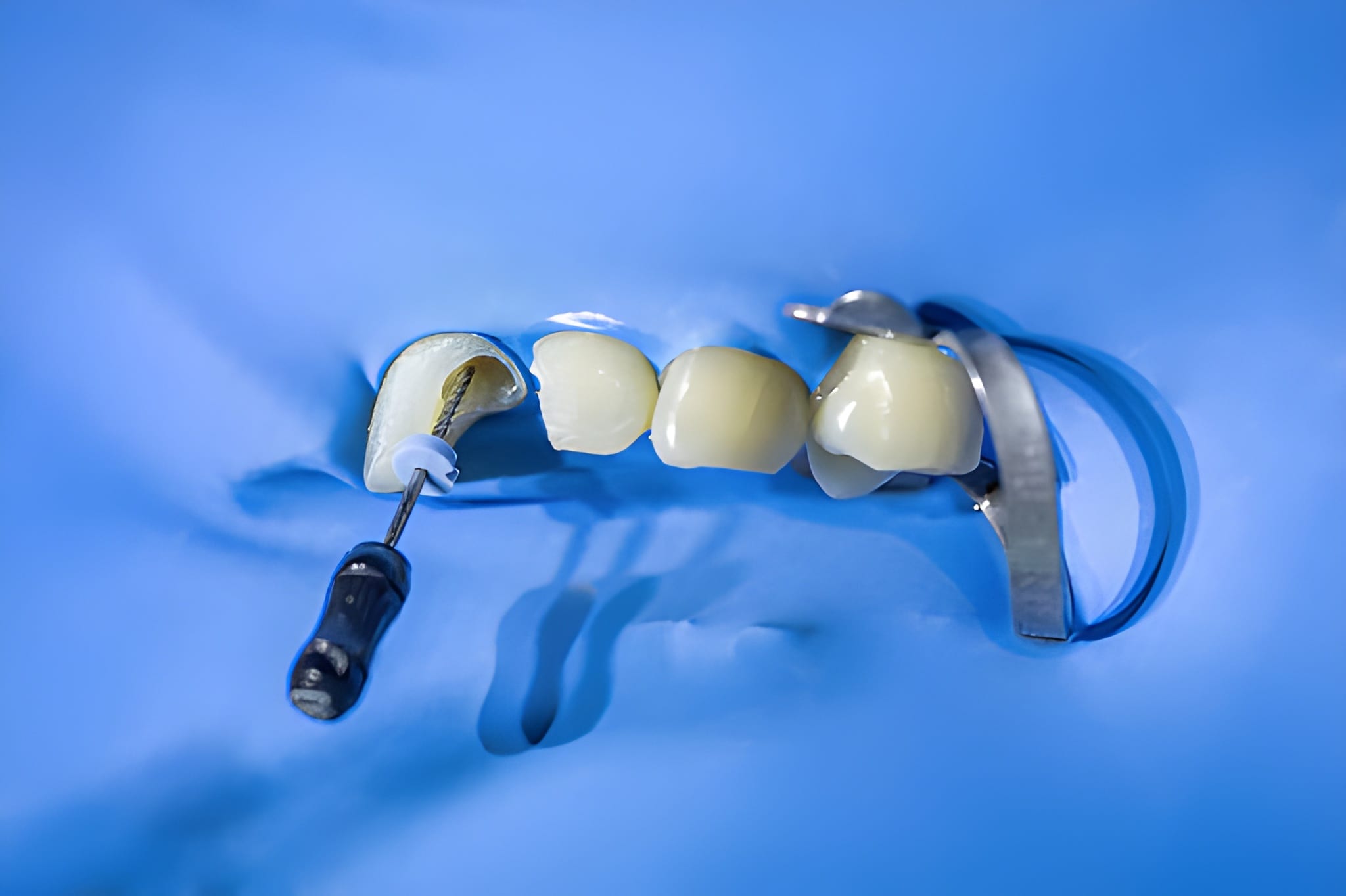 Why Loves Park Patients Trust Loves Park Family Dental for Root Canal Therapy_FI