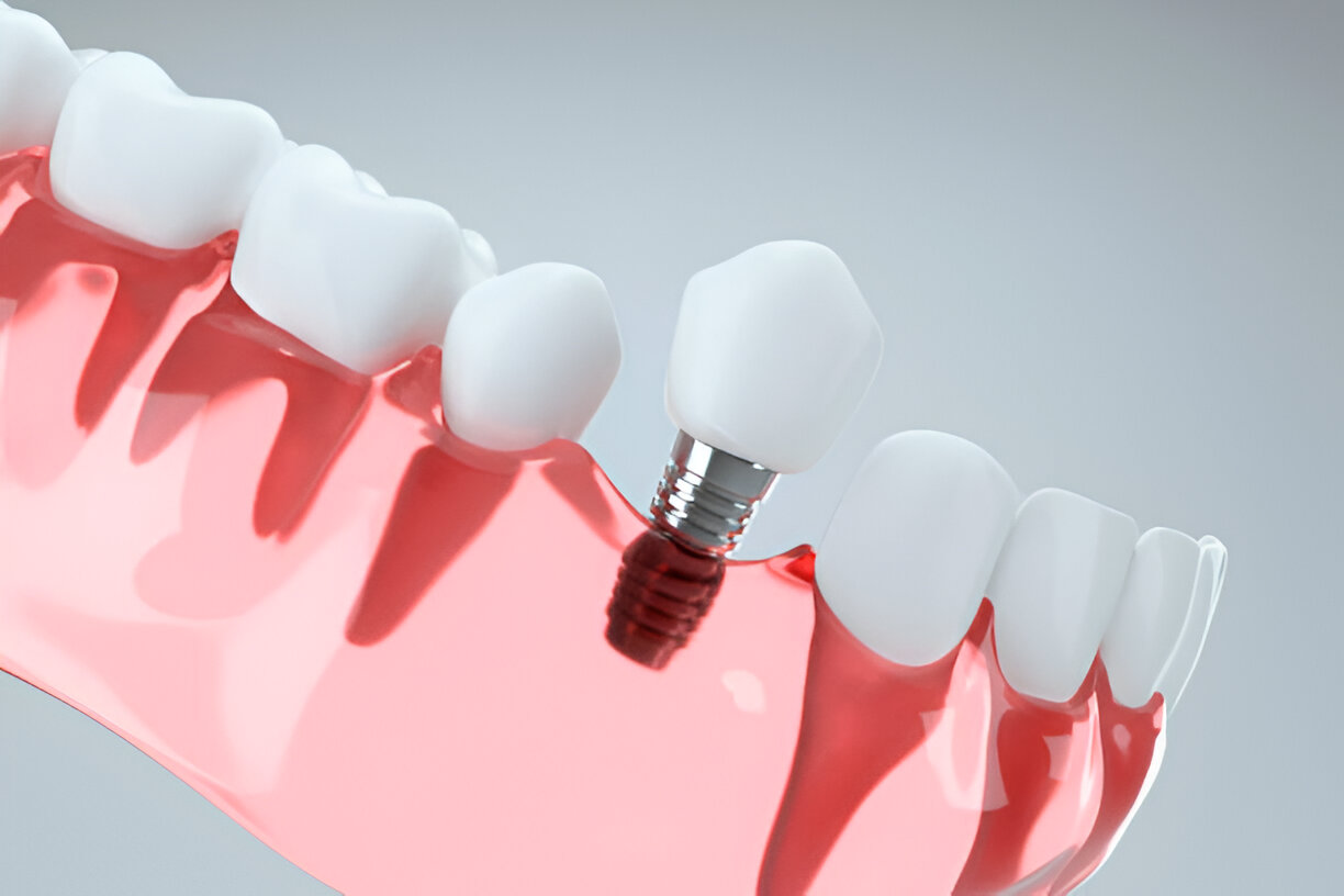 Dental Implants in Loves Park, IL: Restore Your Smile at Loves Park Family Dental and Orthodontics_FI